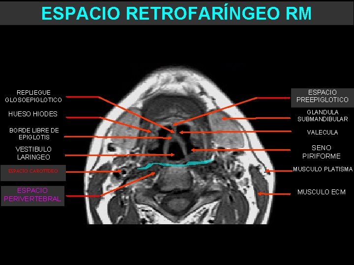 ESPACIO RETROFARÍNGEO RM REPLIEGUE GLOSOEPIGLOTICO ESPACIO PREEPIGLOTICO HUESO HIODES GLANDULA SUBMANDIBULAR BORDE LIBRE DE