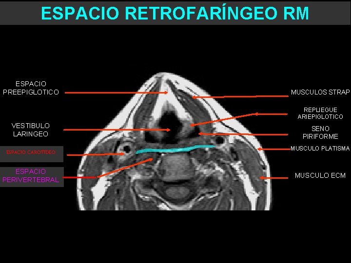 ESPACIO RETROFARÍNGEO RM ESPACIO PREEPIGLOTICO MUSCULOS STRAP REPLIEGUE ARIEPIGLOTICO VESTIBULO LARINGEO ESPACIO CAROTIDEO ESPACIO