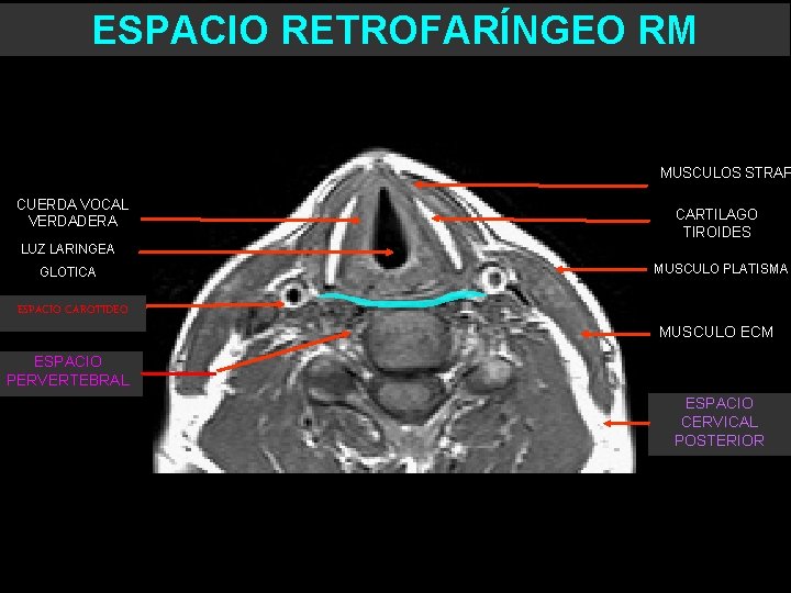 ESPACIO RETROFARÍNGEO RM MUSCULOS STRAP CUERDA VOCAL VERDADERA CARTILAGO TIROIDES LUZ LARINGEA GLOTICA ESPACIO