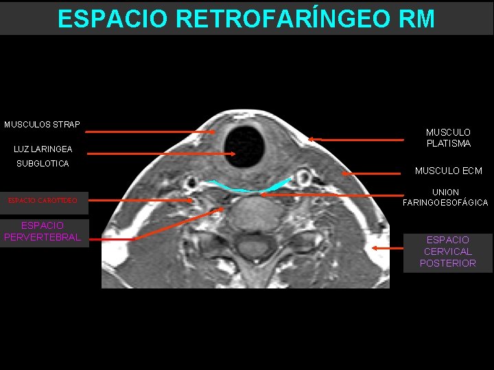 ESPACIO RETROFARÍNGEO RM MUSCULOS STRAP LUZ LARINGEA SUBGLOTICA ESPACIO CAROTIDEO ESPACIO PERVERTEBRAL MUSCULO PLATISMA