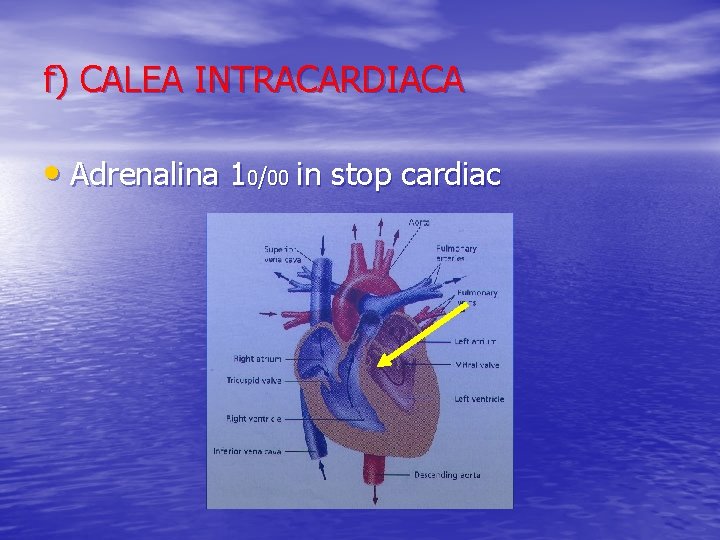 f) CALEA INTRACARDIACA • Adrenalina 10/00 in stop cardiac 