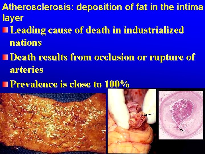 Atherosclerosis: deposition of fat in the intima layer Leading cause of death in industrialized Atherosclerosis: deposition of fat in the intima layer Leading cause of death in industrialized