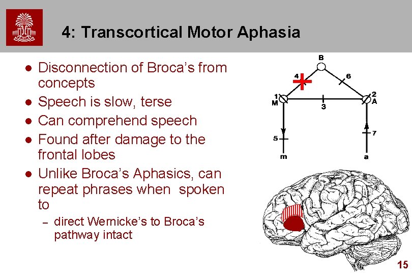 4: Transcortical Motor Aphasia l l l Disconnection of Broca’s from concepts Speech is