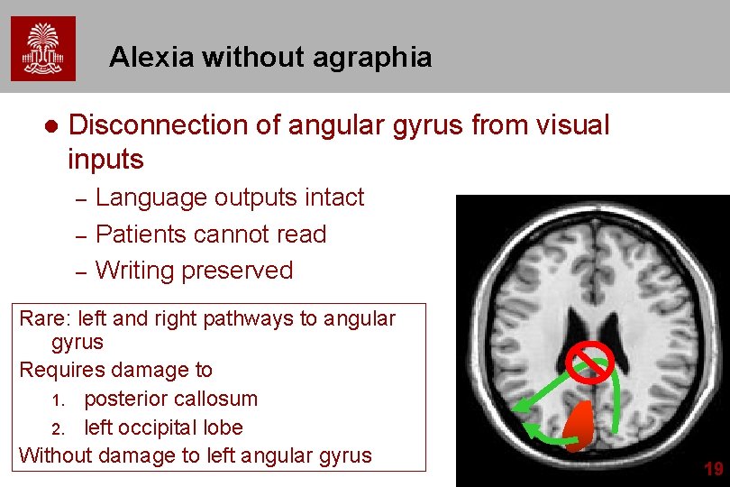 Alexia without agraphia l Disconnection of angular gyrus from visual inputs – – –