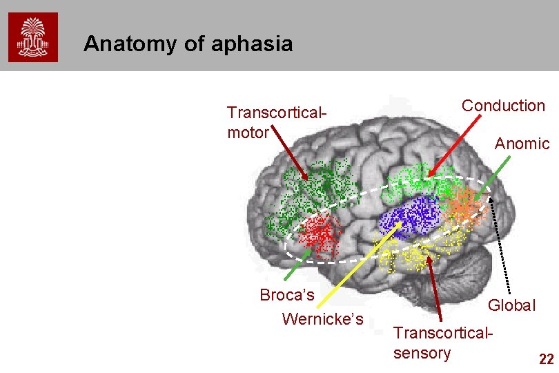 Anatomy of aphasia Transcorticalmotor Broca’s Wernicke’s Conduction Anomic Global Transcorticalsensory 22 