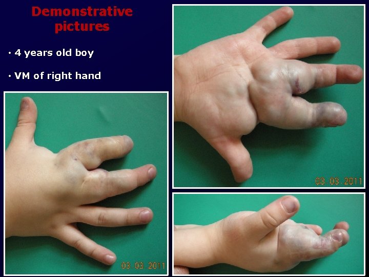 Demonstrative pictures • 4 years old boy • VM of right hand 