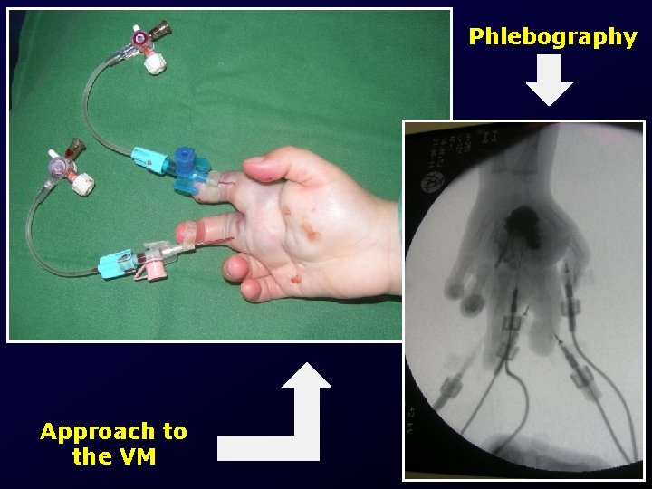 Phlebography Approach to the VM 