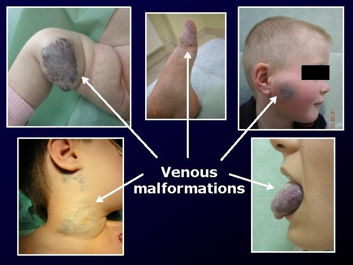 Venous malformations 