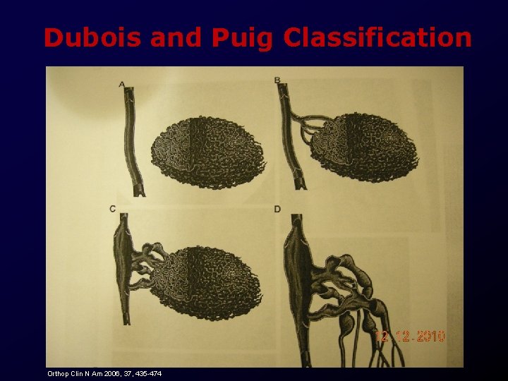 Dubois and Puig Classification Orthop Clin N Am 2006, 37, 435 -474 