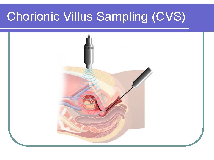 Chorionic Villus Sampling (CVS) Chorionic Villus Sampling (CVS)