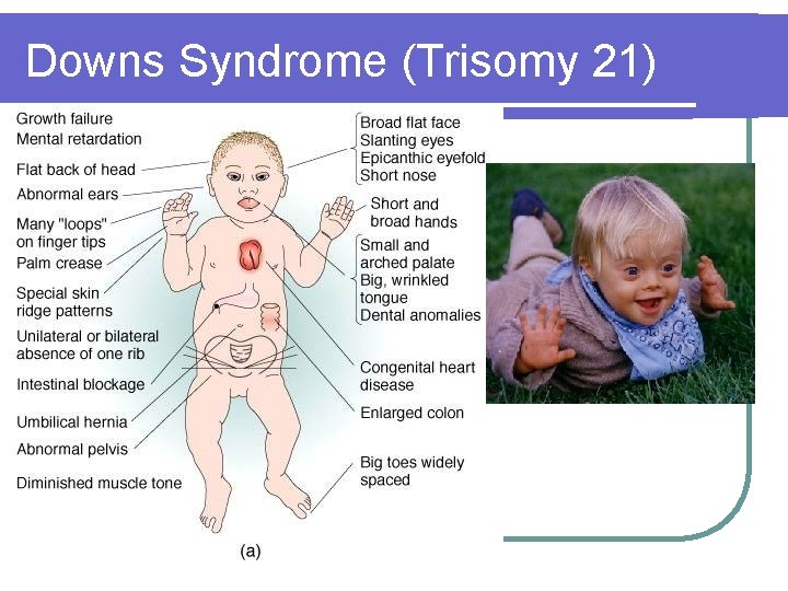 Downs Syndrome (Trisomy 21) Downs Syndrome (Trisomy 21)
