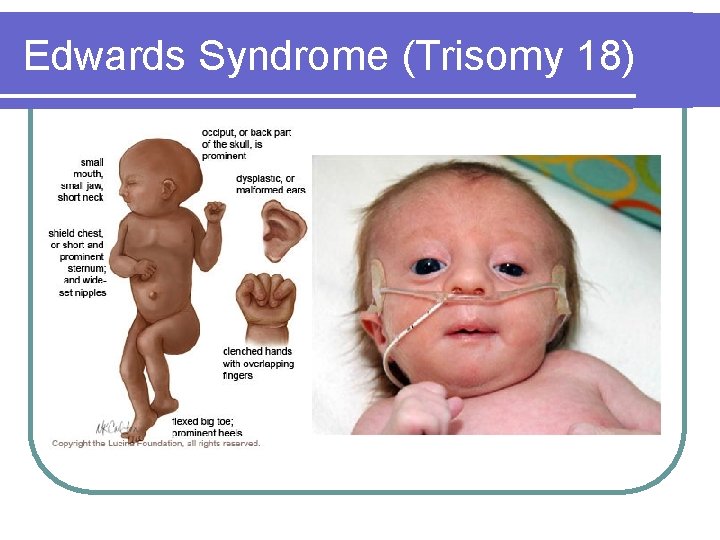 Edwards Syndrome (Trisomy 18) Edwards Syndrome (Trisomy 18)