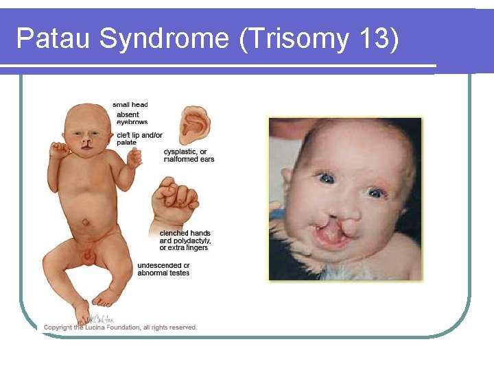 Patau Syndrome (Trisomy 13) Patau Syndrome (Trisomy 13)