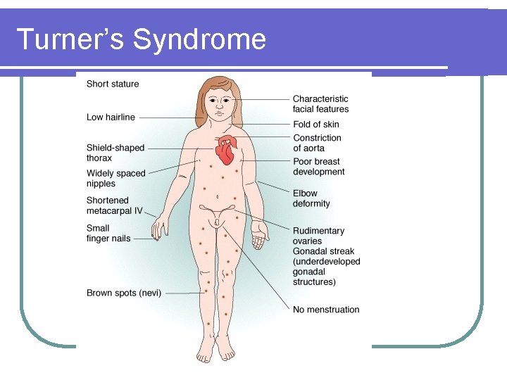 Turner’s Syndrome Turner’s Syndrome