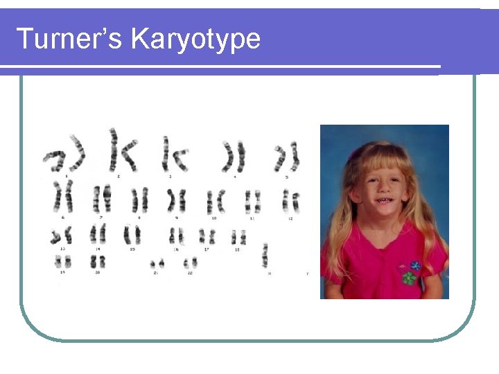 Turner’s Karyotype Turner’s Karyotype