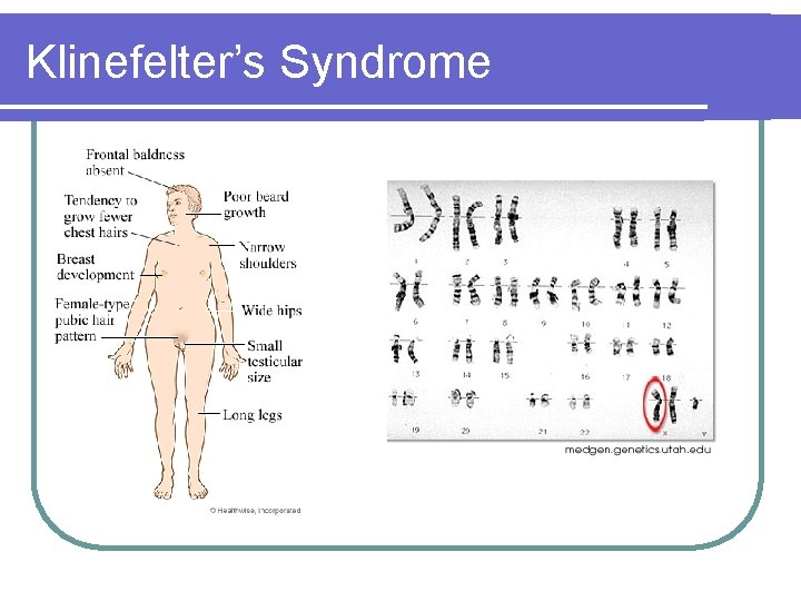 Klinefelter’s Syndrome Klinefelter’s Syndrome
