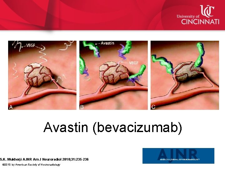 Avastin (bevacizumab) S. K. Mukherji AJNR Am J Neuroradiol 2010; 31: 235 -236 ©