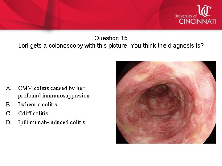 Question 15 Lori gets a colonoscopy with this picture. You think the diagnosis is?