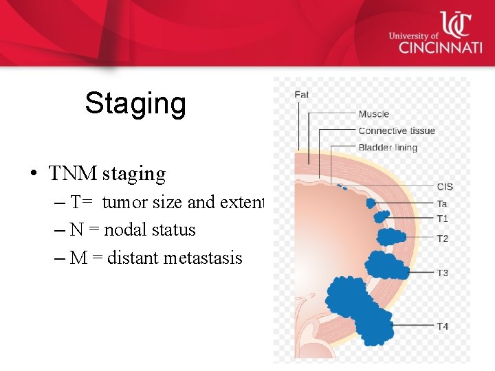 Staging • TNM staging – T= tumor size and extent – N = nodal