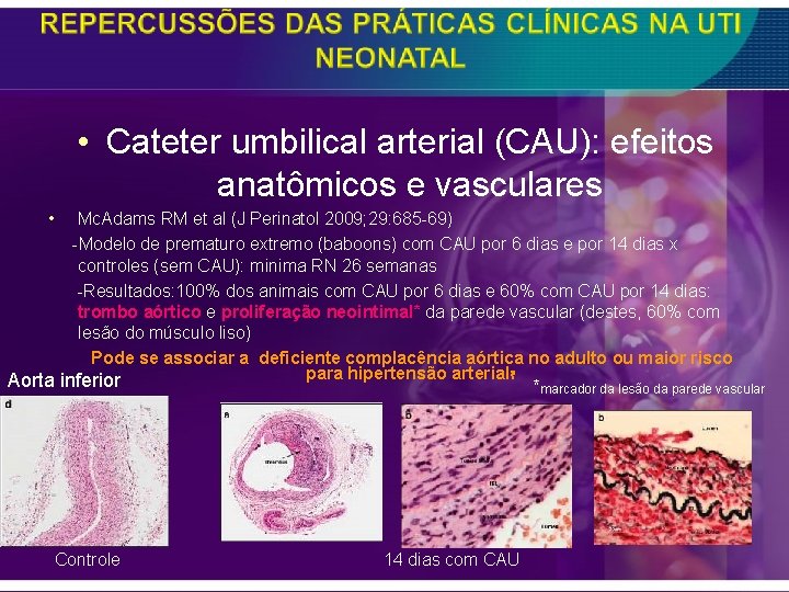  • Cateter umbilical arterial (CAU): efeitos anatômicos e vasculares • Mc. Adams RM