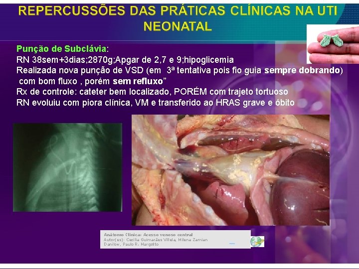 Punção de Subclávia: RN 38 sem+3 dias; 2870 g; Apgar de 2, 7 e