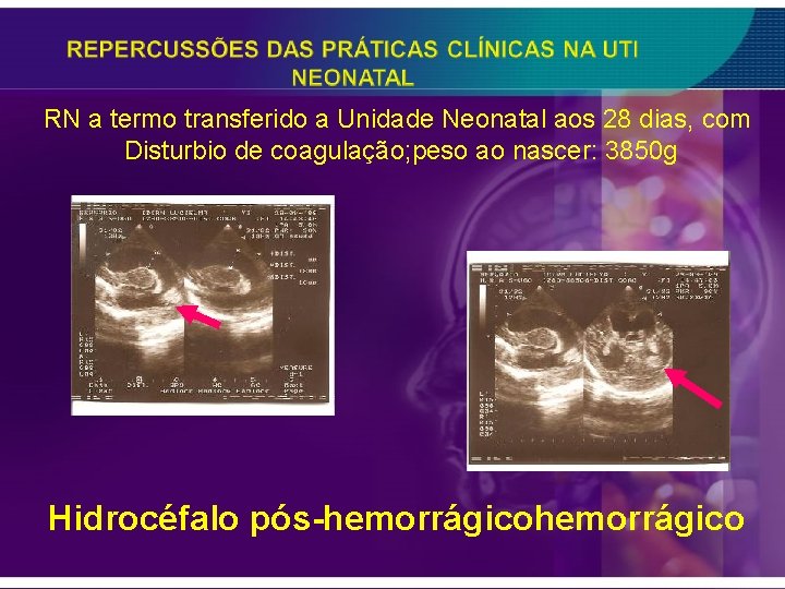 RN a termo transferido a Unidade Neonatal aos 28 dias, com Disturbio de coagulação;