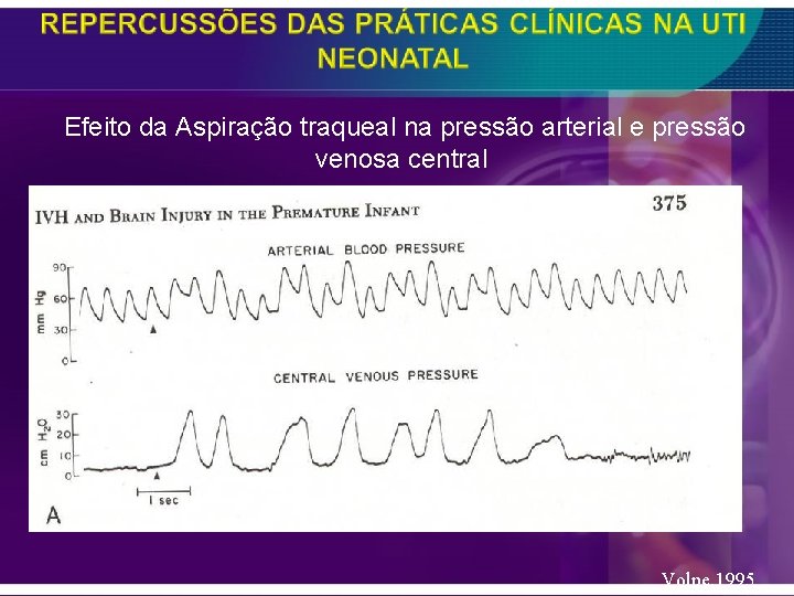  Efeito da Aspiração traqueal na pressão arterial e pressão venosa central Volpe, 1995