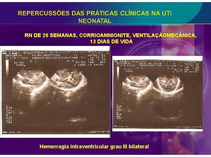 RN DE 26 SEMANAS, CORRIOAMNIONITE, VENTILAÇÃOMEC NICA, 13 DIAS DE VIDA Hemorragia intraventricular grau