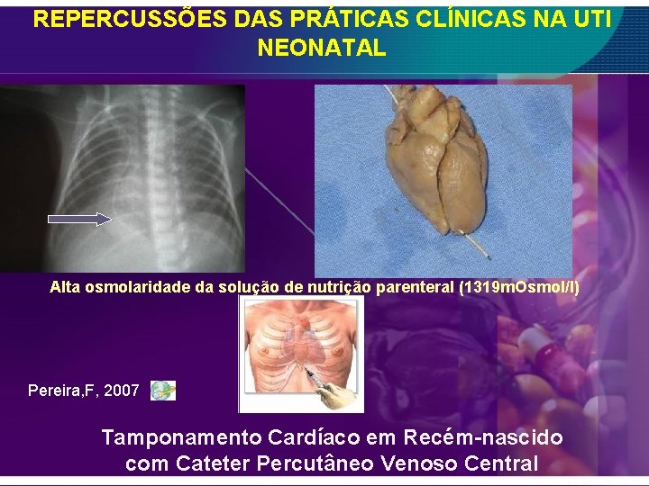 REPERCUSSÕES DAS PRÁTICAS CLÍNICAS NA UTI NEONATAL Alta osmolaridade da solução de nutrição parenteral