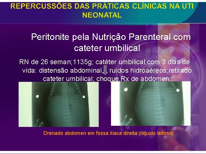  Peritonite pela Nutrição Parenteral com cateter umbilical RN de 26 seman; 1135 g;