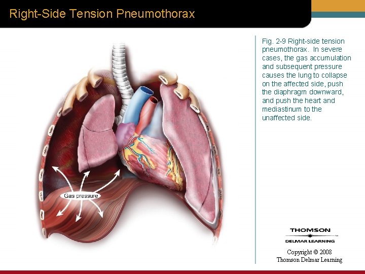 Right-Side Tension Pneumothorax Fig. 2 -9 Right-side tension pneumothorax. In severe cases, the gas