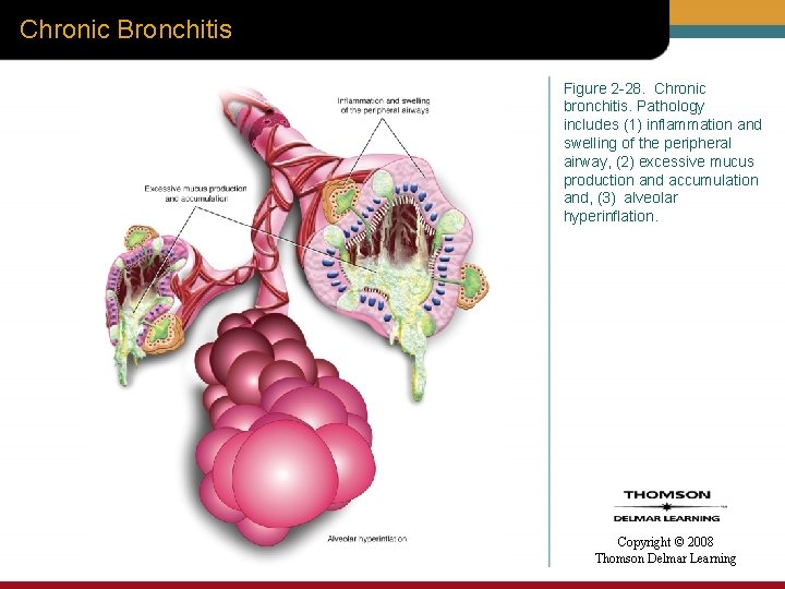 Chronic Bronchitis Figure 2 -28. Chronic bronchitis. Pathology includes (1) inflammation and swelling of