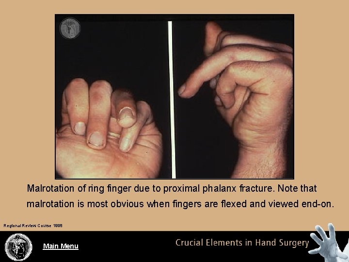 Malrotation of ring finger due to proximal phalanx fracture. Note that malrotation is most