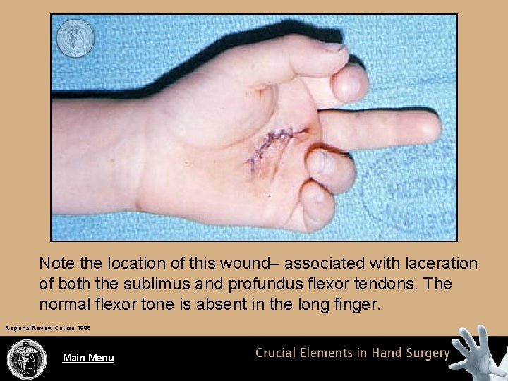 Note the location of this wound– associated with laceration of both the sublimus and