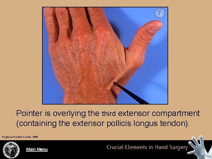 Pointer is overlying the third extensor compartment (containing the extensor pollicis longus tendon). Regional
