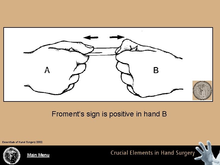 Froment’s sign is positive in hand B Essentials of Hand Surgery 2002 Main Menu