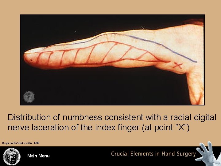 Distribution of numbness consistent with a radial digital nerve laceration of the index finger