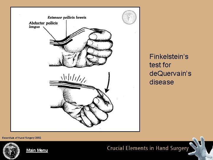 Finkelstein’s test for de. Quervain’s disease Essentials of Hand Surgery 2002 Main Menu 