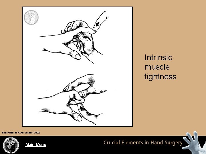 Intrinsic muscle tightness Essentials of Hand Surgery 2002 Main Menu 