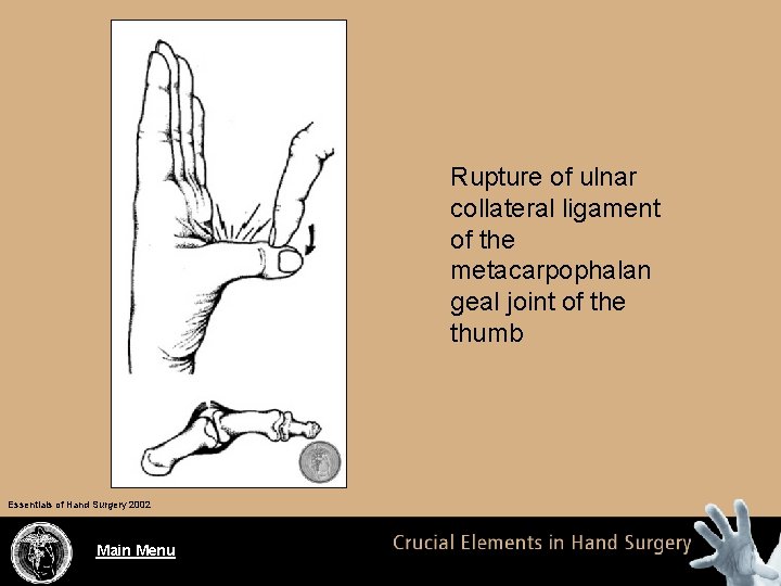 Rupture of ulnar collateral ligament of the metacarpophalan geal joint of the thumb Essentials