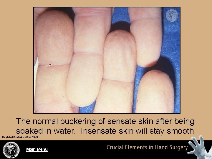 The normal puckering of sensate skin after being soaked in water. Insensate skin will
