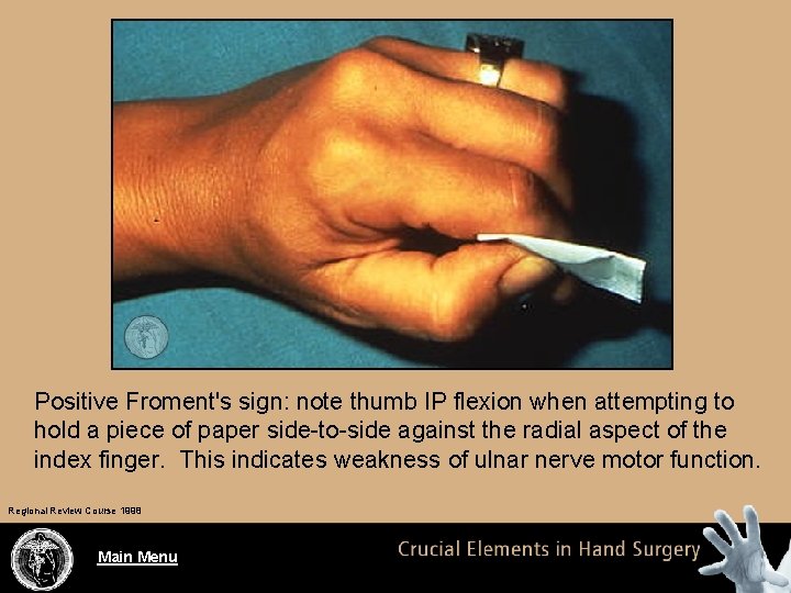 Positive Froment's sign: note thumb IP flexion when attempting to hold a piece of