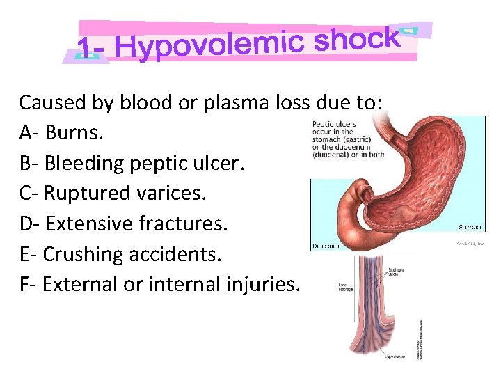 Caused by blood or plasma loss due to: A- Burns. B- Bleeding peptic ulcer.