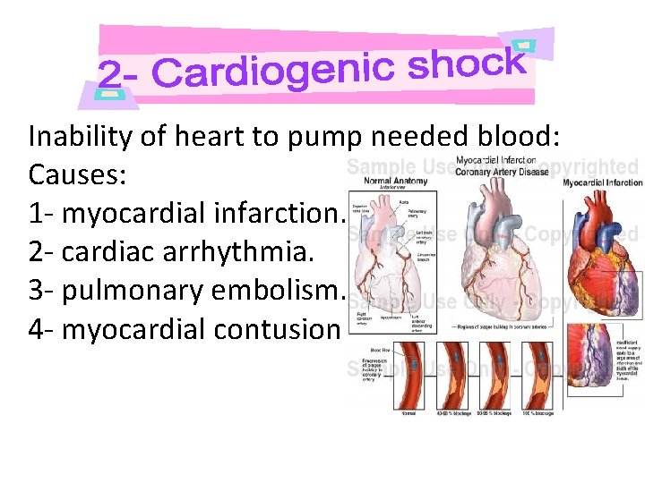 Inability of heart to pump needed blood: Causes: 1 - myocardial infarction. 2 -