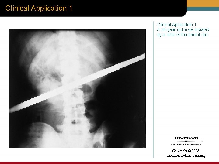 Clinical Application 1: A 34 -year-old male impaled by a steel enforcement rod. Copyright