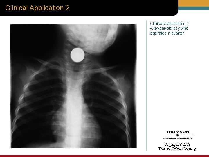 Clinical Application 2: A 4 -year-old boy who aspirated a quarter. Copyright © 2008