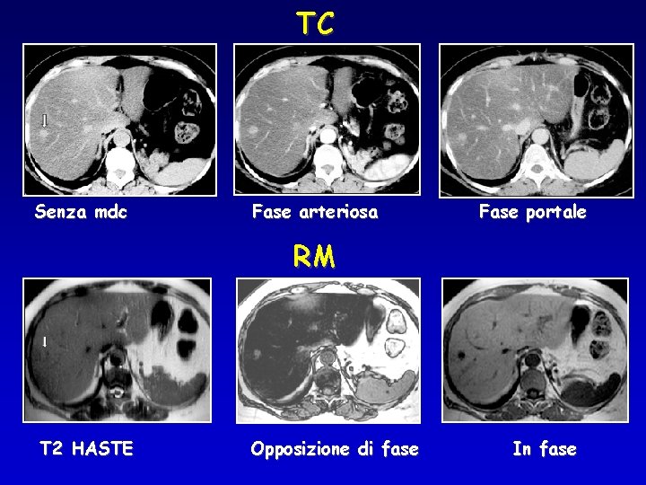 TC Senza mdc Fase arteriosa Fase portale RM T 2 HASTE Opposizione di fase
