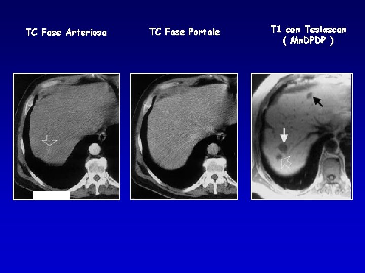 TC Fase Arteriosa TC Fase Portale T 1 con Teslascan ( Mn. DPDP )