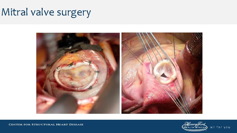 Mitral valve surgery 