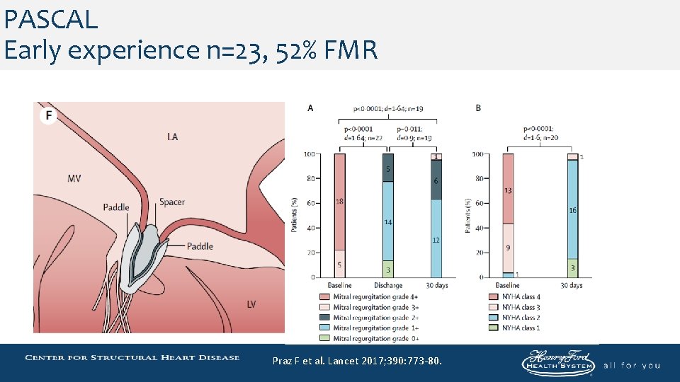 PASCAL Early experience n=23, 52% FMR Praz F et al. Lancet 2017; 390: 773